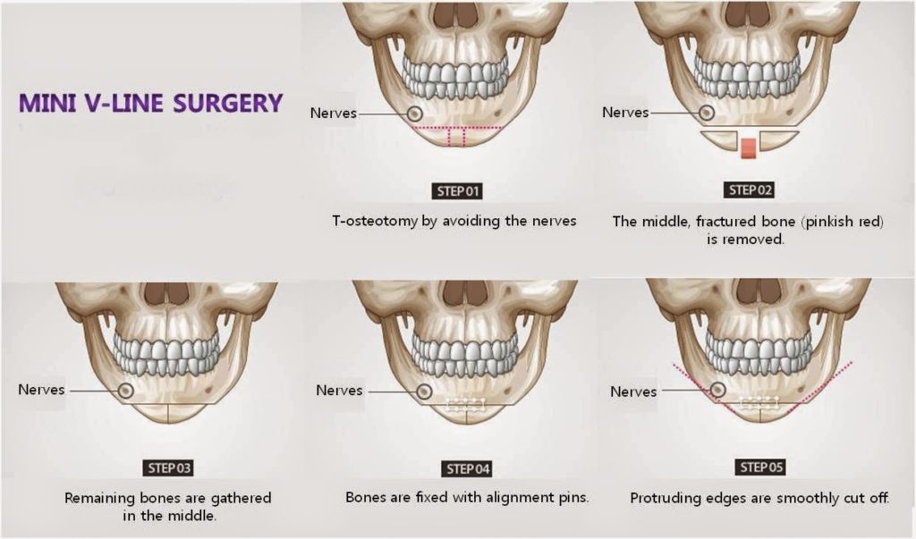 Chin Surgery Johannesburg | Dr Nebil Lahouel