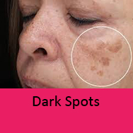 dark spots