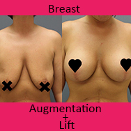 breastaugmentationlift