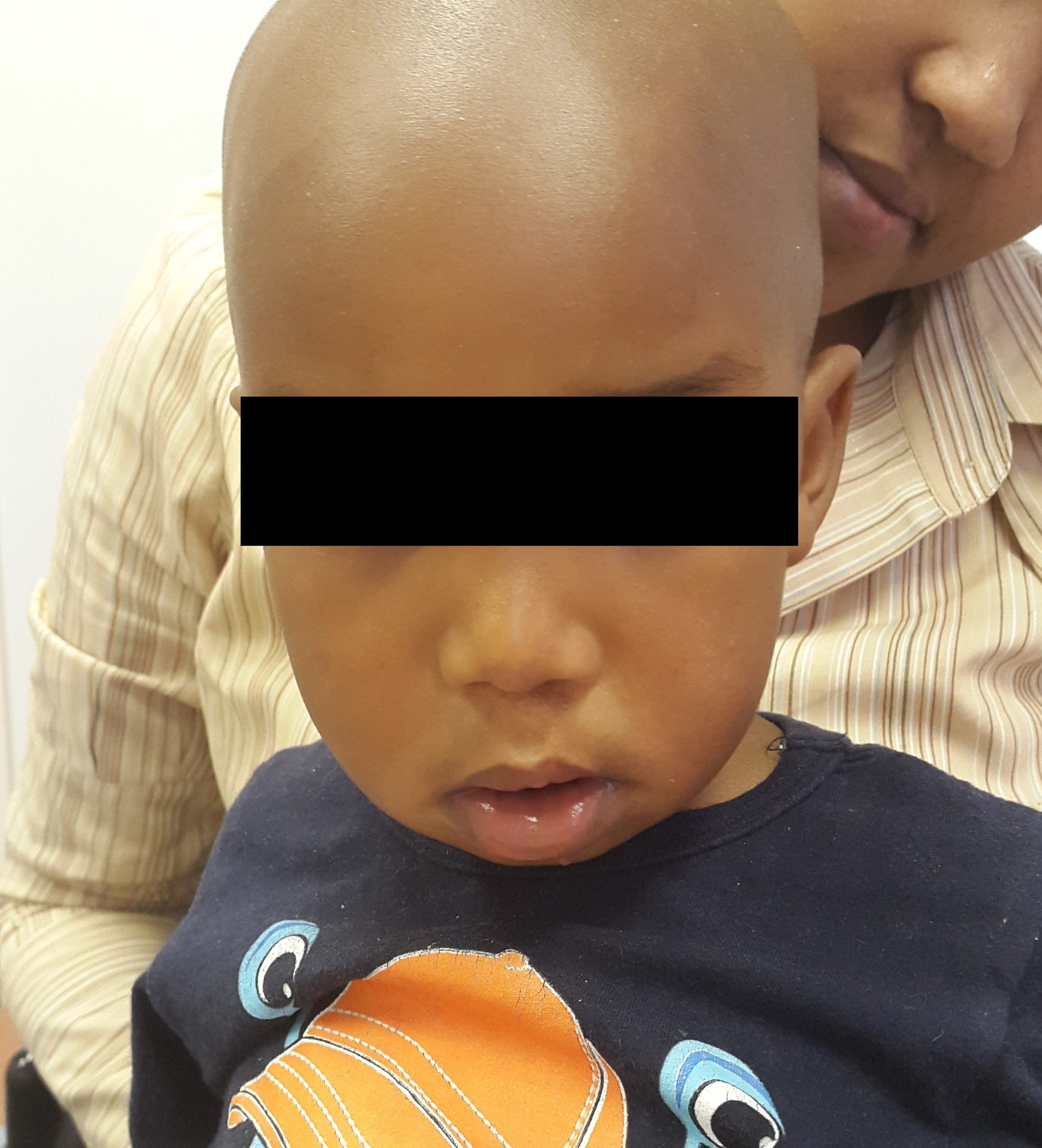 cleft lip by Dr Lahouel after 2 year