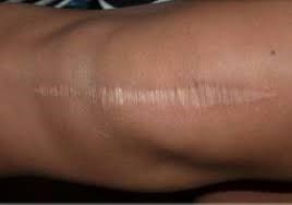 hypotrophic or stretched scar